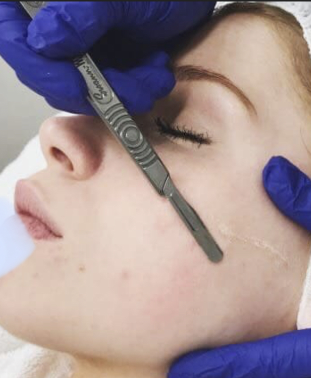 Dermaplane Facial Treatment