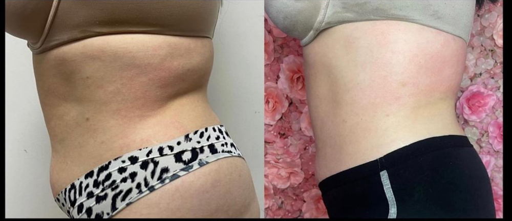 Skin Tightening