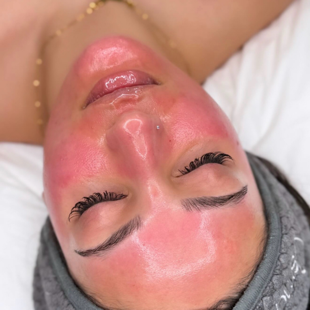 Microneedling at Marta Rabelo Skin & Laser in Malden, MA