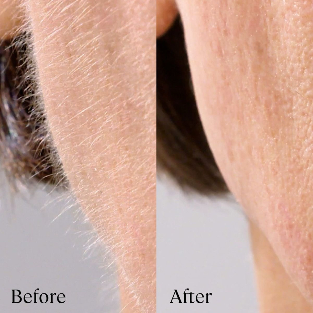 Add - On Dermaplanning