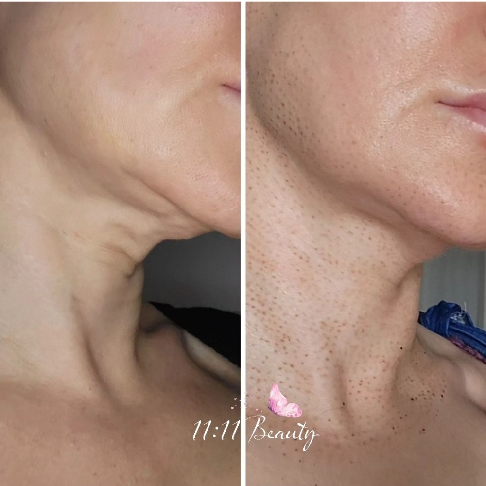 Fibroblast Neck