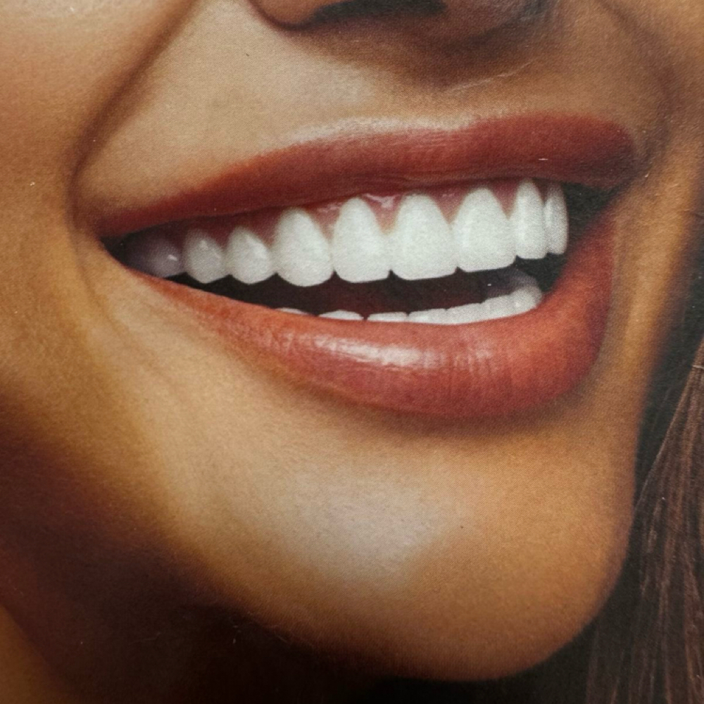 Teeth Whitening Treatment at Bare Esthetics Medical Spa LLC in Idabel, OK