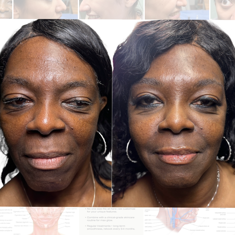 Biostimulator Consultation at BlackBird Aesthetics in Fort Worth, TX
