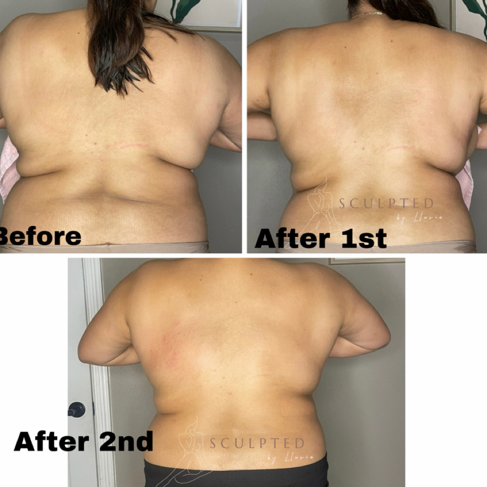 Slim Back 3 Session Special at Sculpted by Lluvia in Weslaco, TX