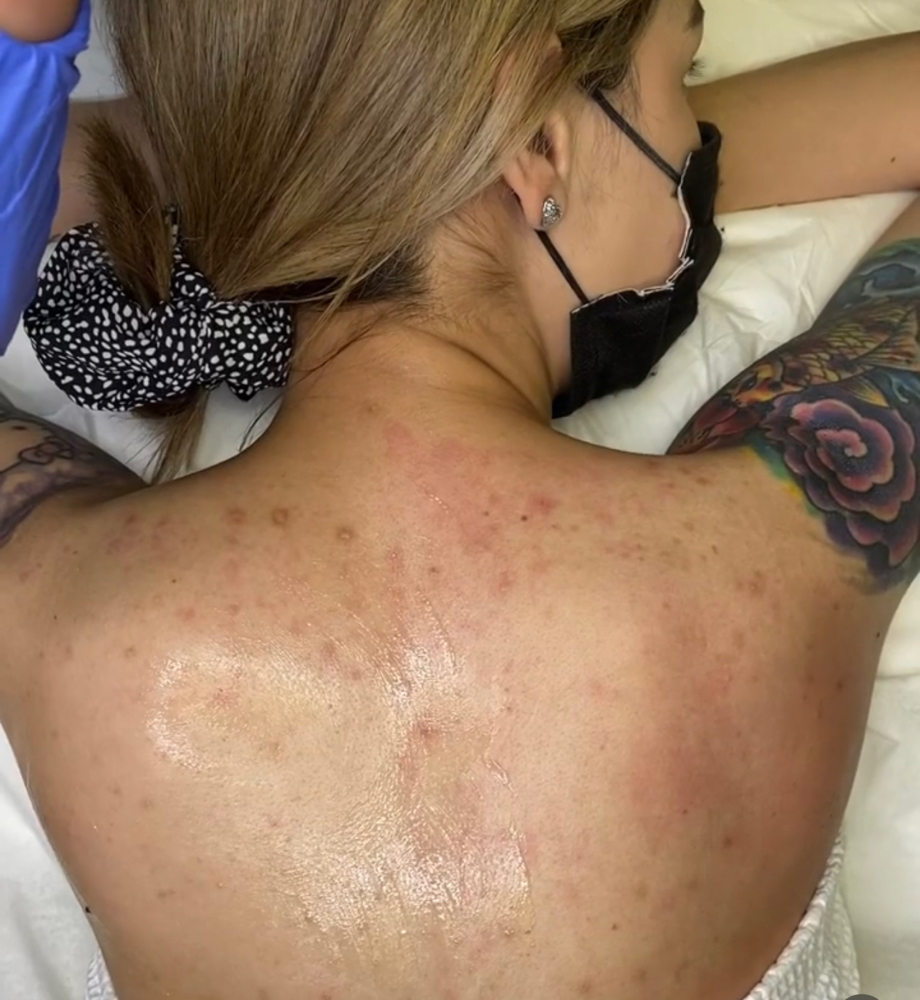 Bare Back Peel
