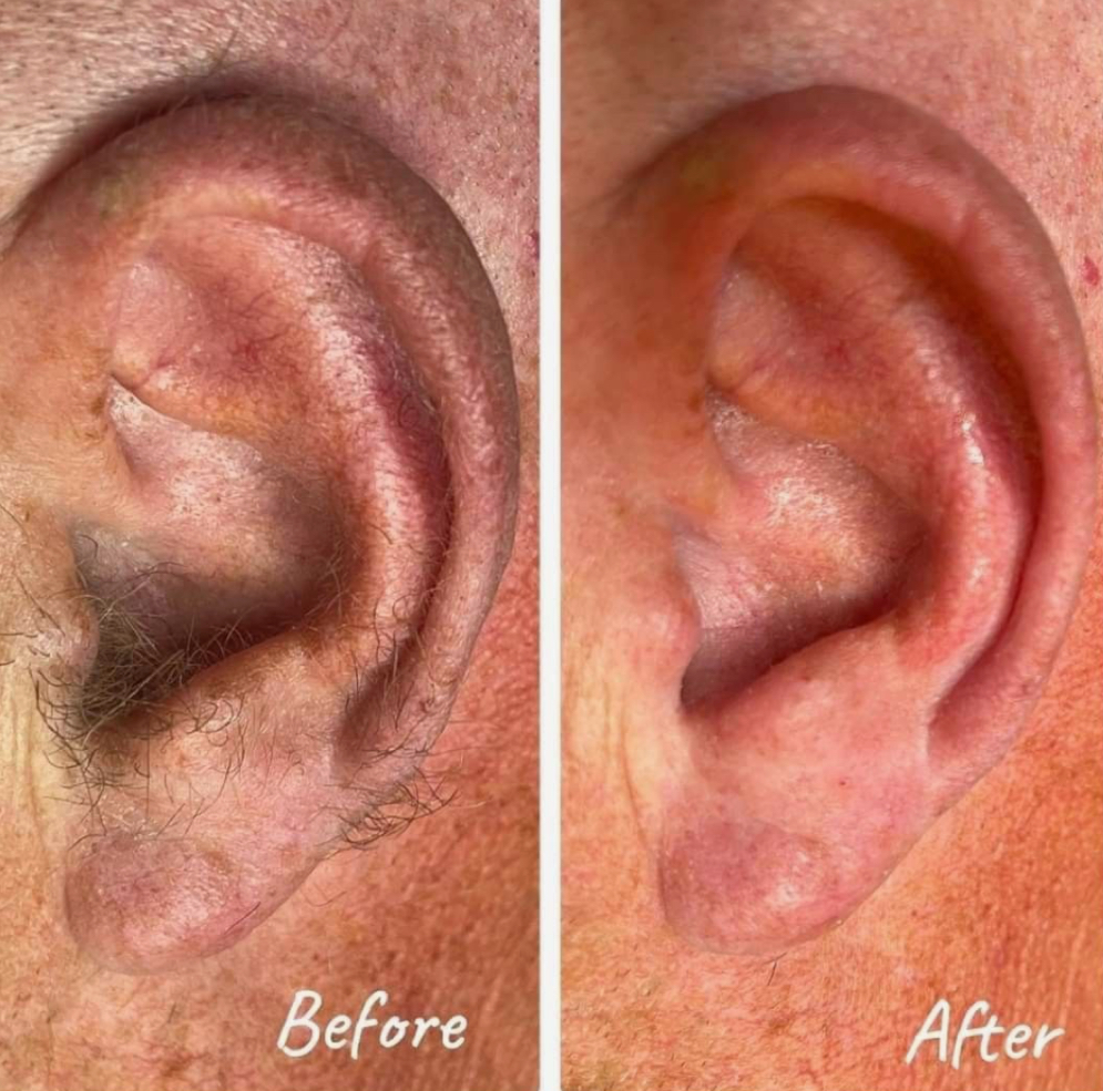 Ear Waxing