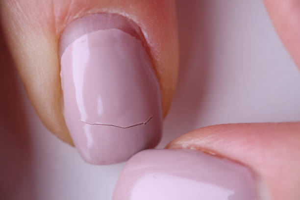 Nail repair
