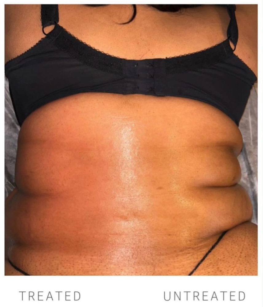 Ultrasonic Cavitation