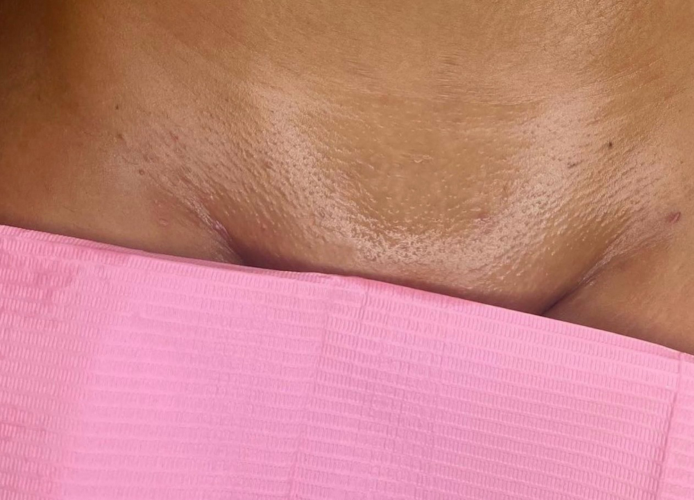 Brazilian wax