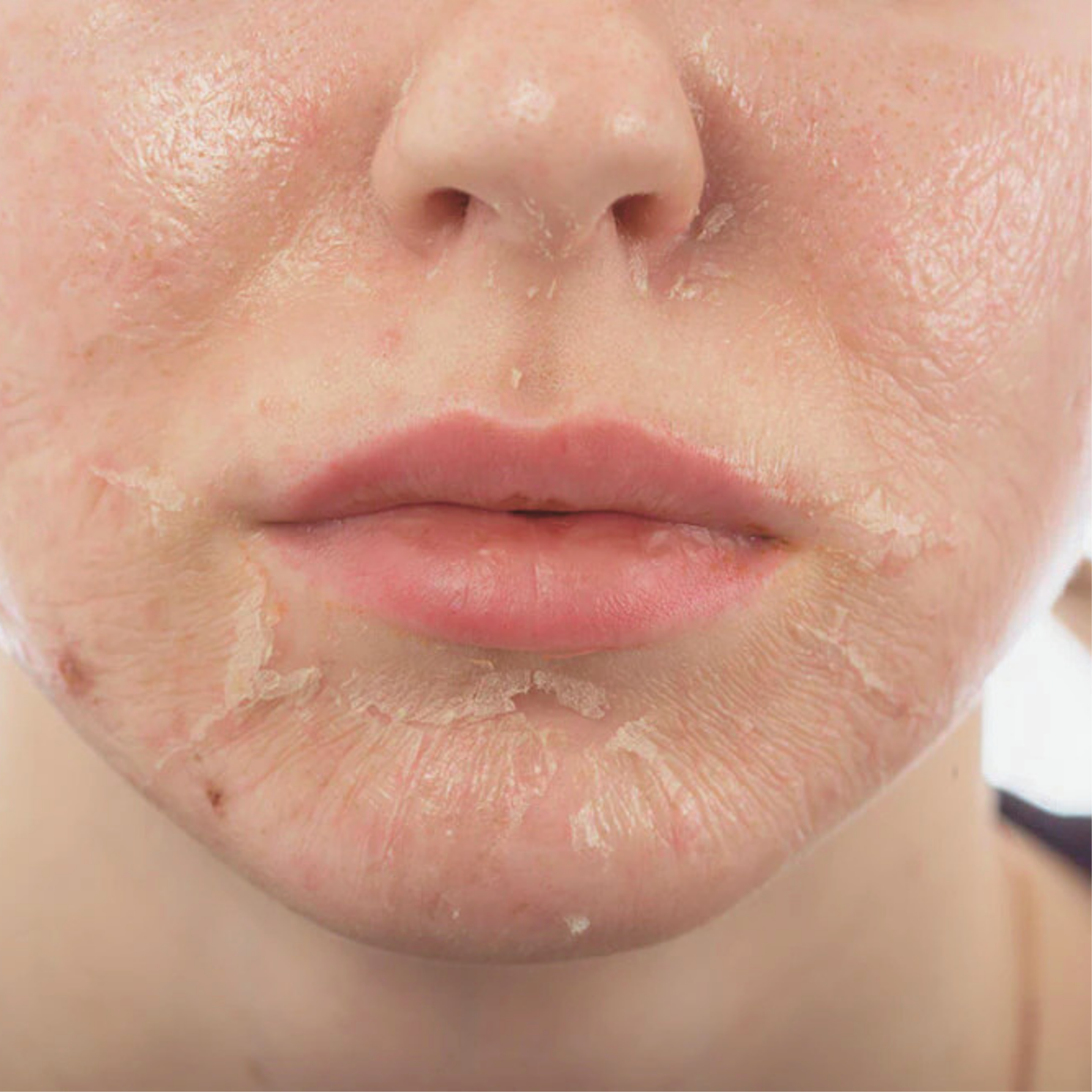 The Power Peel | Anti-Aging at Arcana Med Spa in Castle Rock, CO