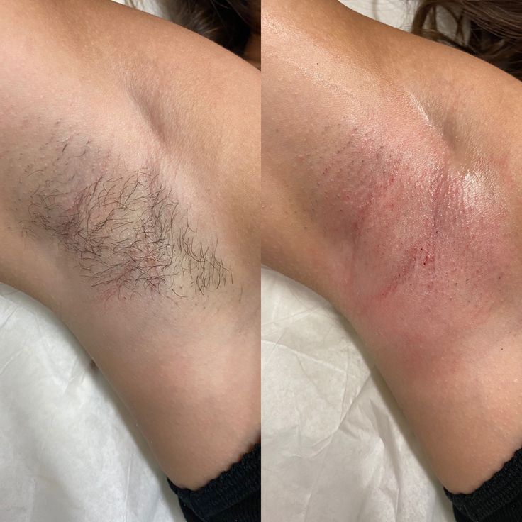 Underarm Wax
