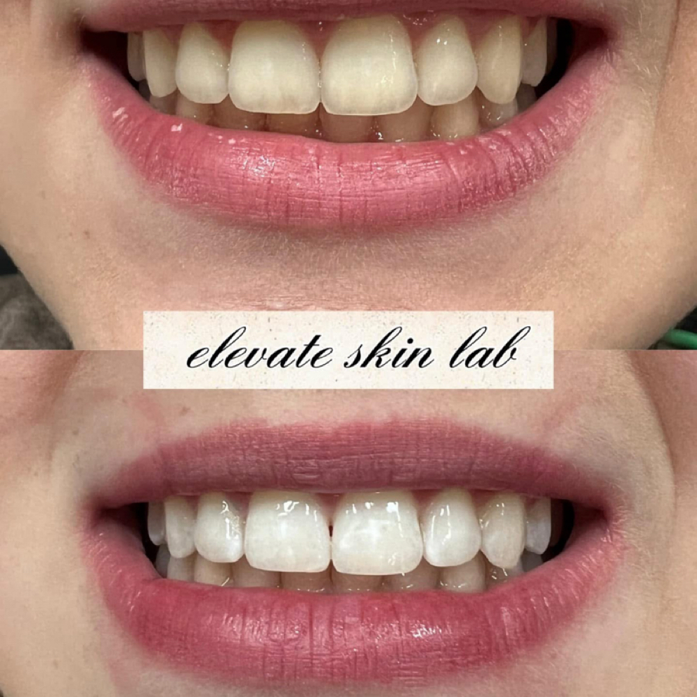 Laser Teeth Whitening at Elevate Skin Lab in Desloge, MO