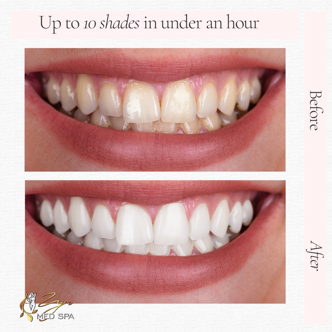 Teeth Whitening