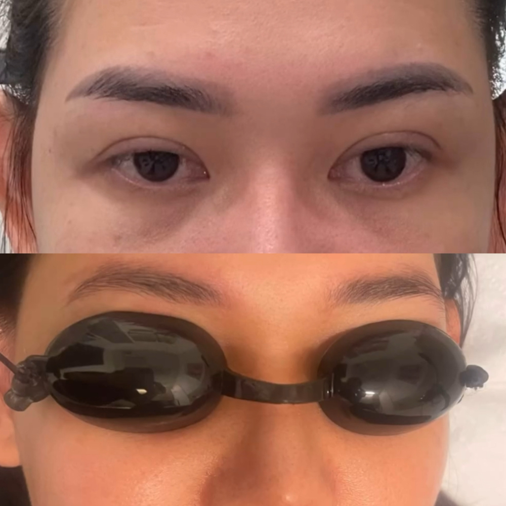 Laser Eyebrows Tattoo Removal