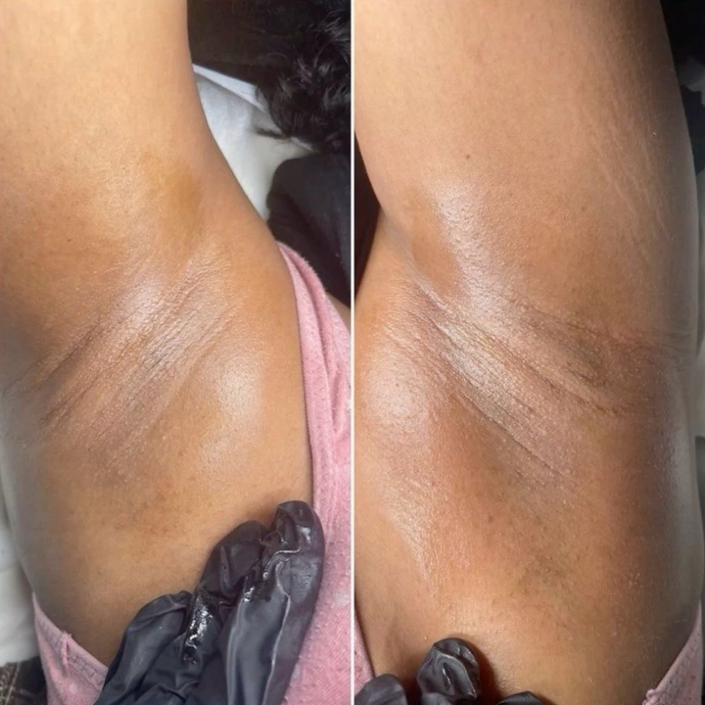 Underarm Brightening Peel at LeDaé Beautí in Lafayette, LA