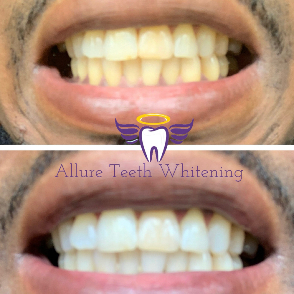 The Diamond Smile at Allure Teeth Whitening in Greensboro, NC