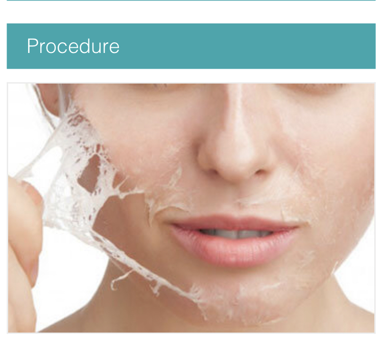 Personalized Chemical Peel