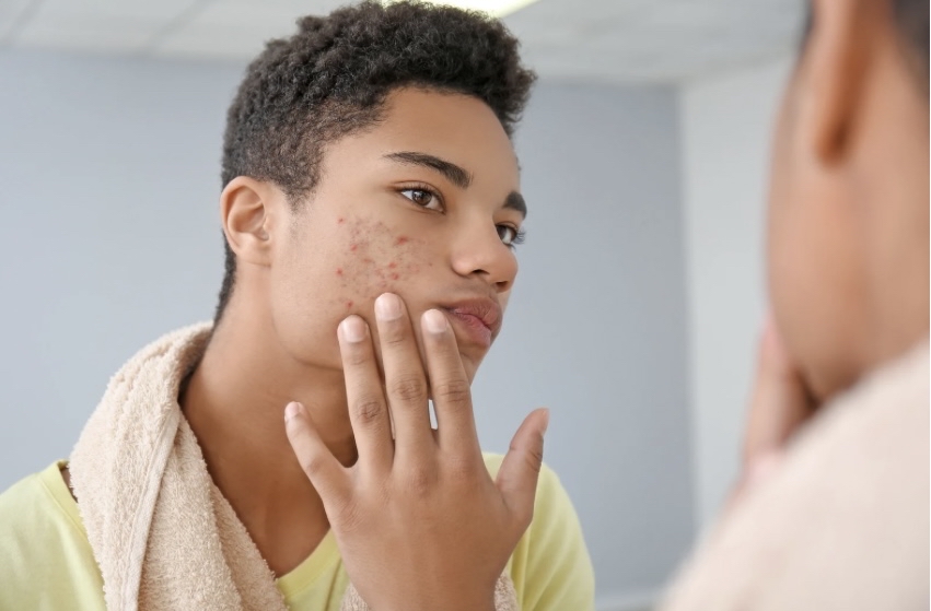 Teen Acne Facial