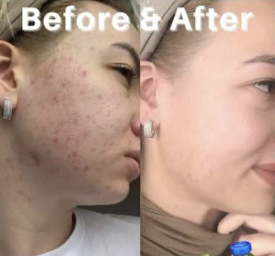 Derma Clean Acne Treatment