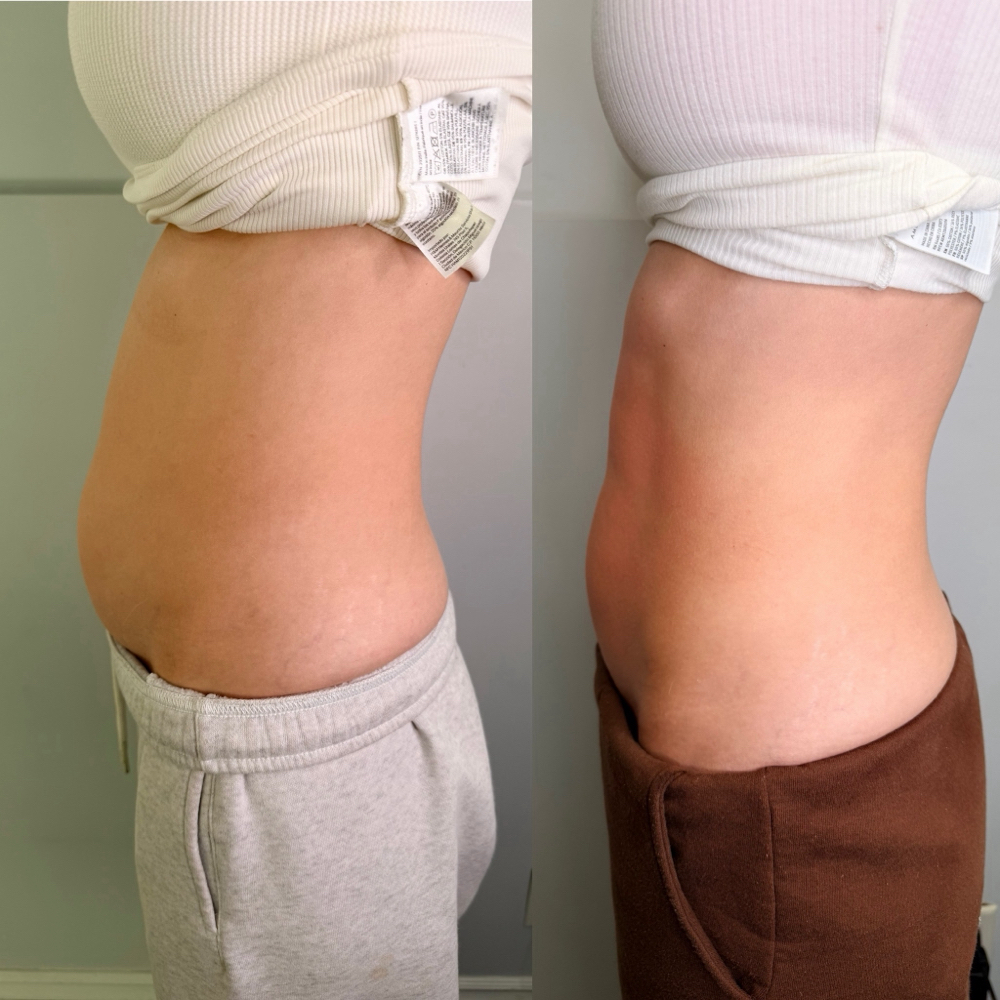 Cyro Body Sculpting Aand Slimming at Bunny Boutique And Wax Bar in Ventura, CA
