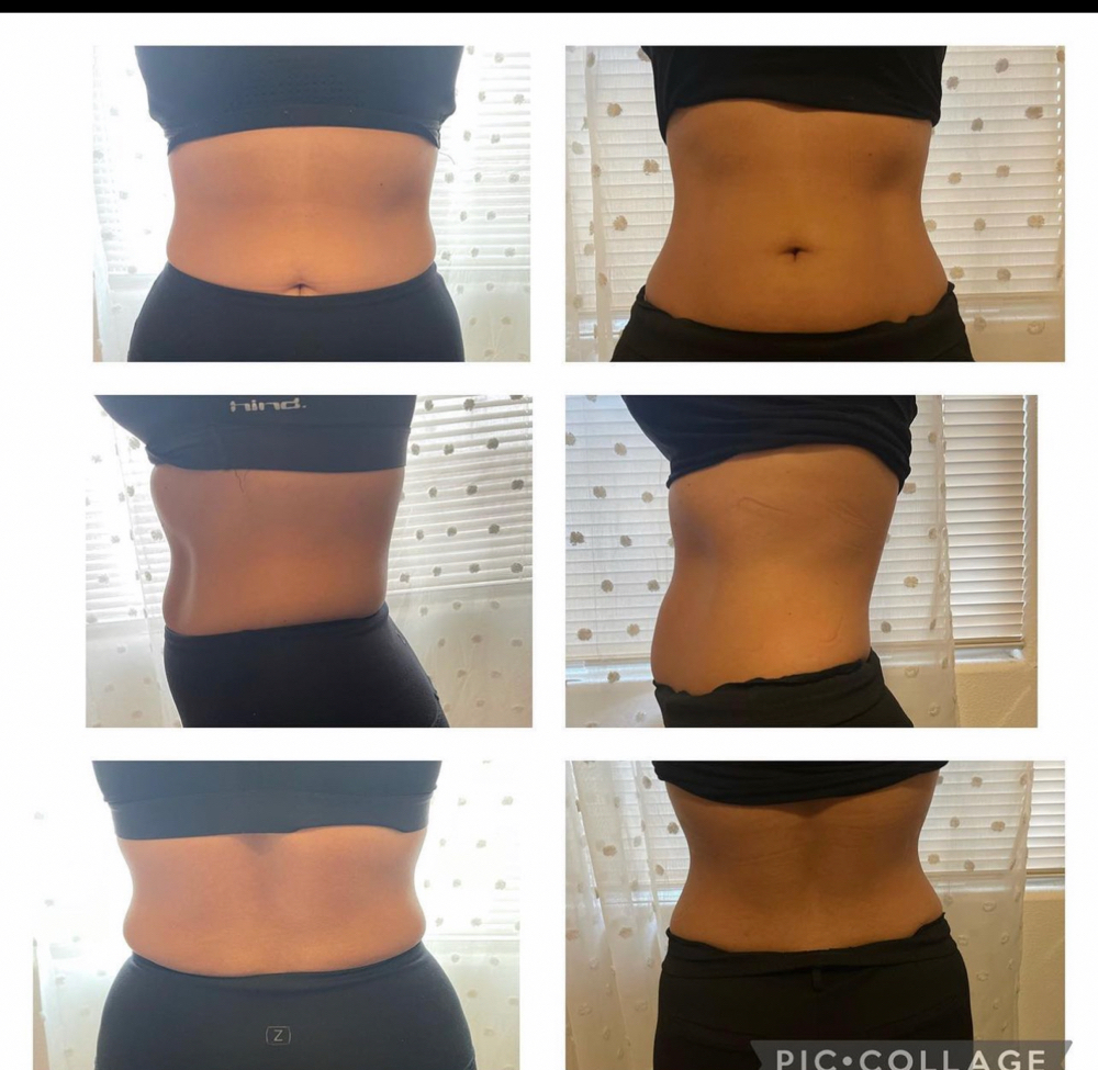 Lipo & Tightening 3 Sessions