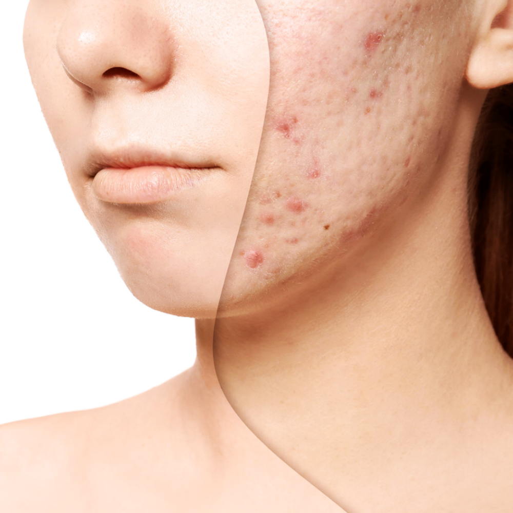 Anti-Acne Facial