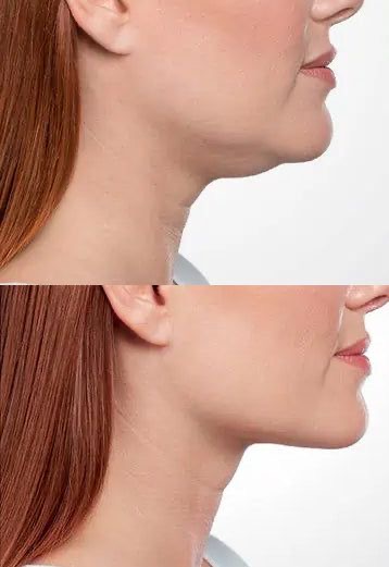 Lipo-Dissolve: Small Area