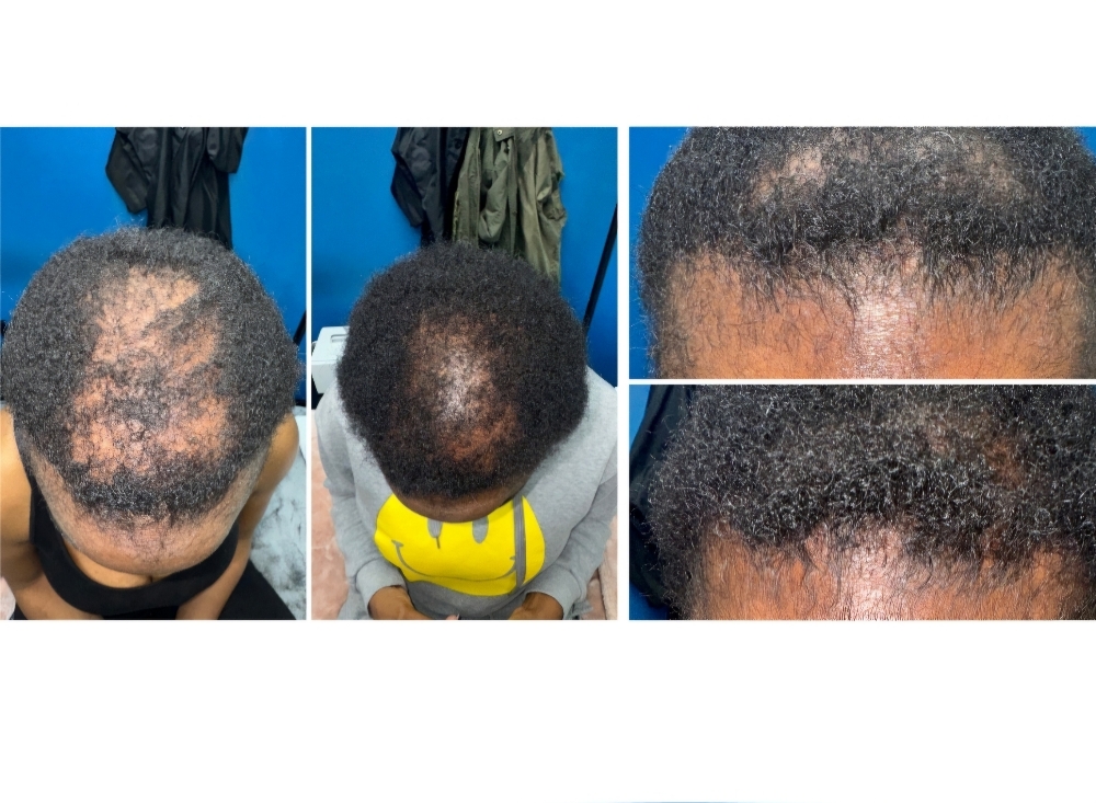 Microneedling Version
