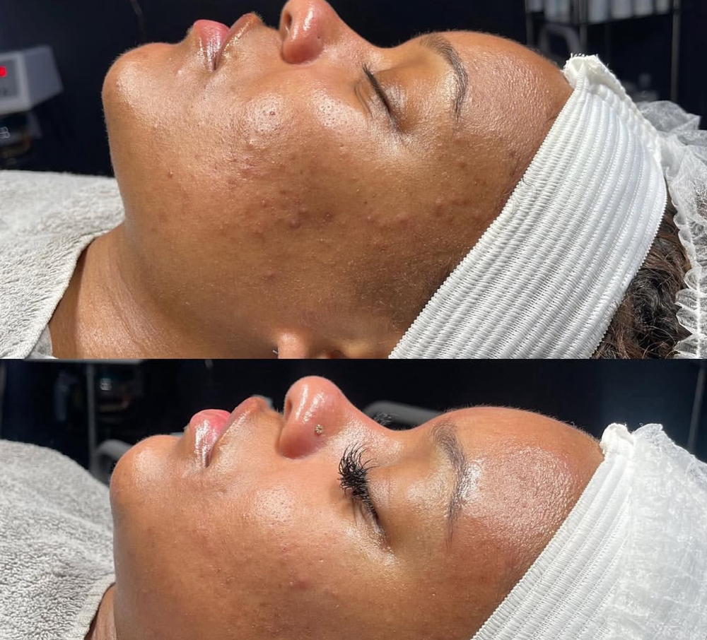 Acne Clear Advantage
