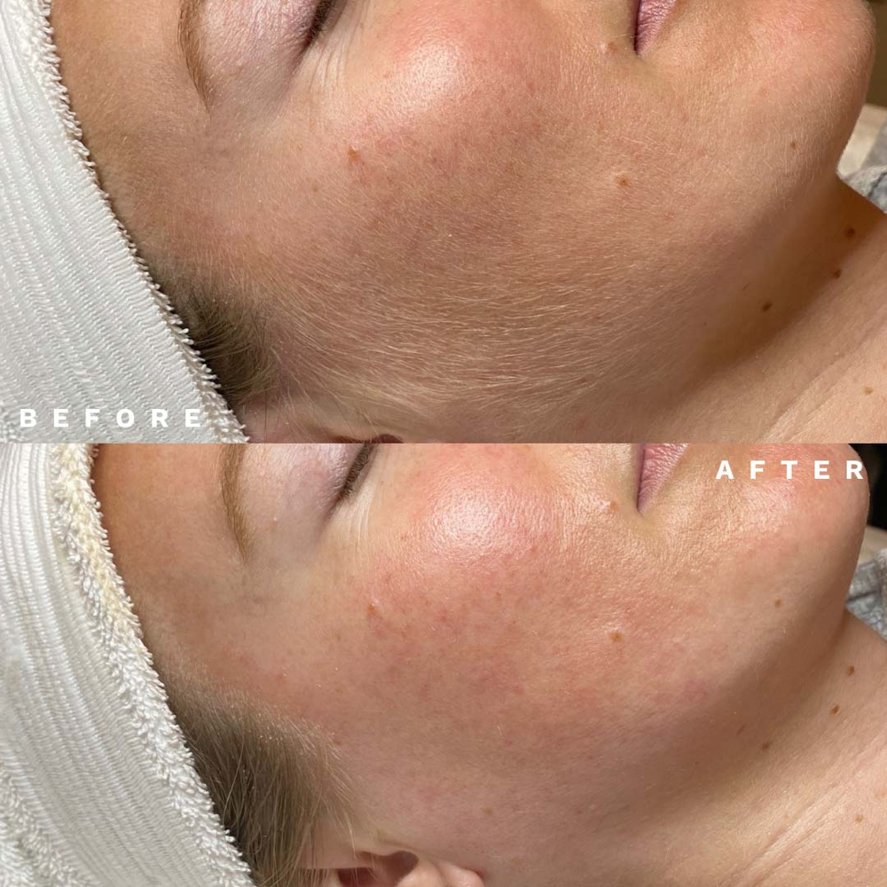 Resurfacing Facial