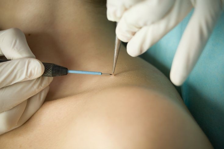 Warts Removal (session)