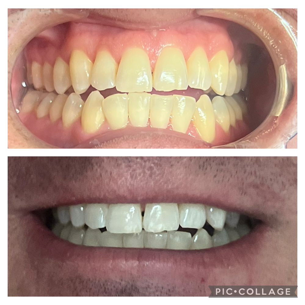 Teeth Whitening