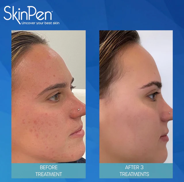 Micro needling Package of (3)