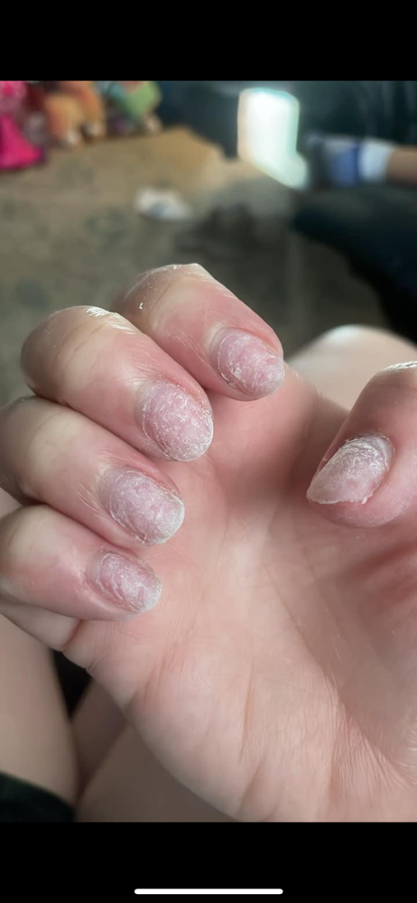 Acrylic Removal