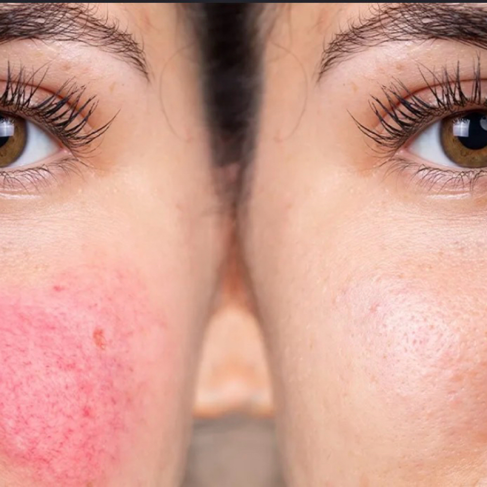Rosacea Relief Facial at The Fine Line in Buffalo, NY