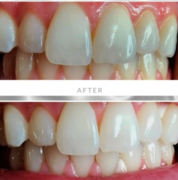 Red Carpet Teeth Whitening
