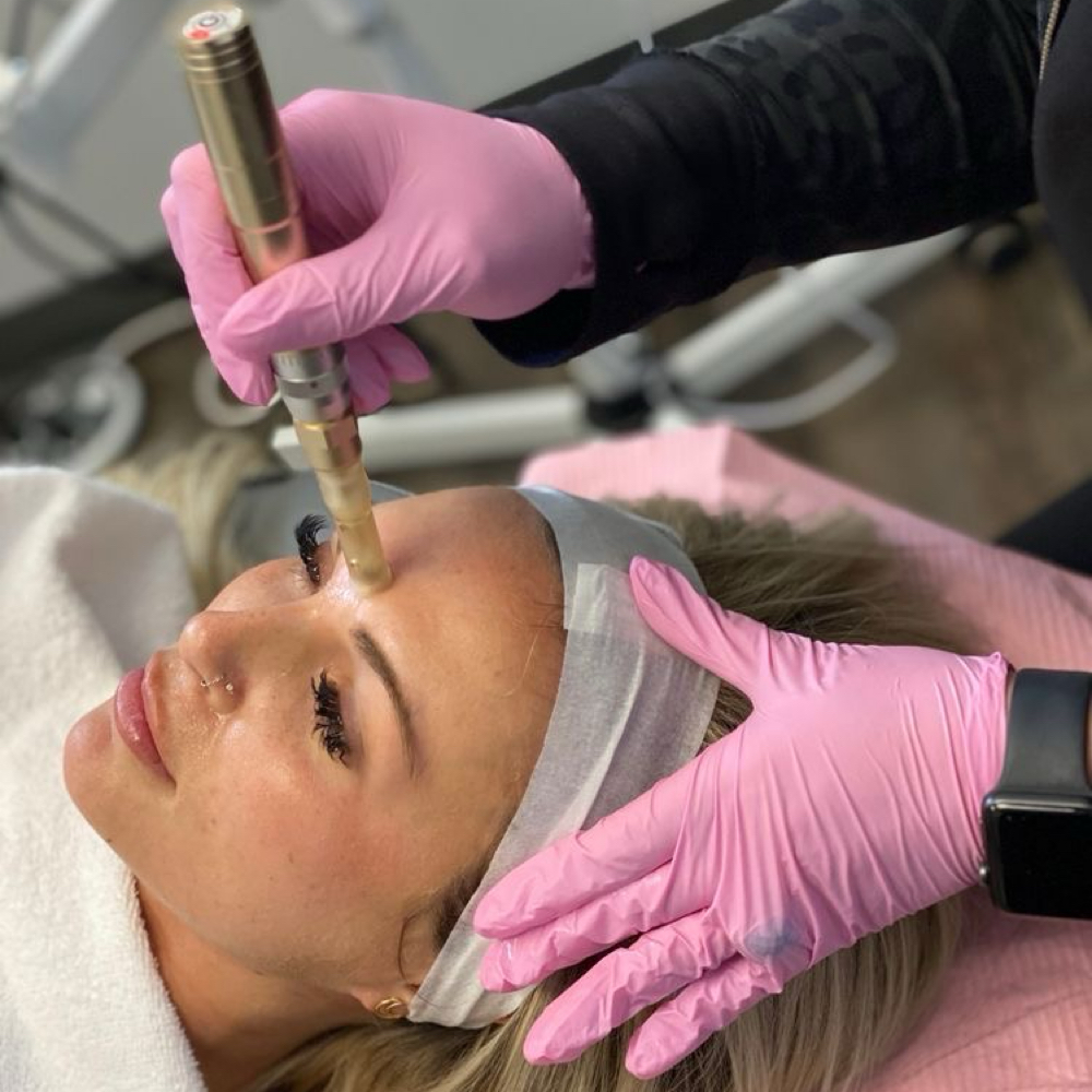 Microneedling Collagen Renewal at Skin Deep Beauty Spa in Sulphur, LA