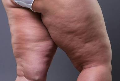 Cellulite Reduction Package