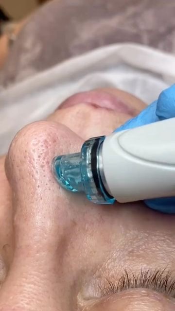 Hyrodermabrasion