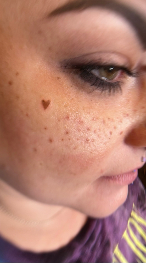 Heart Freckle/Mole
