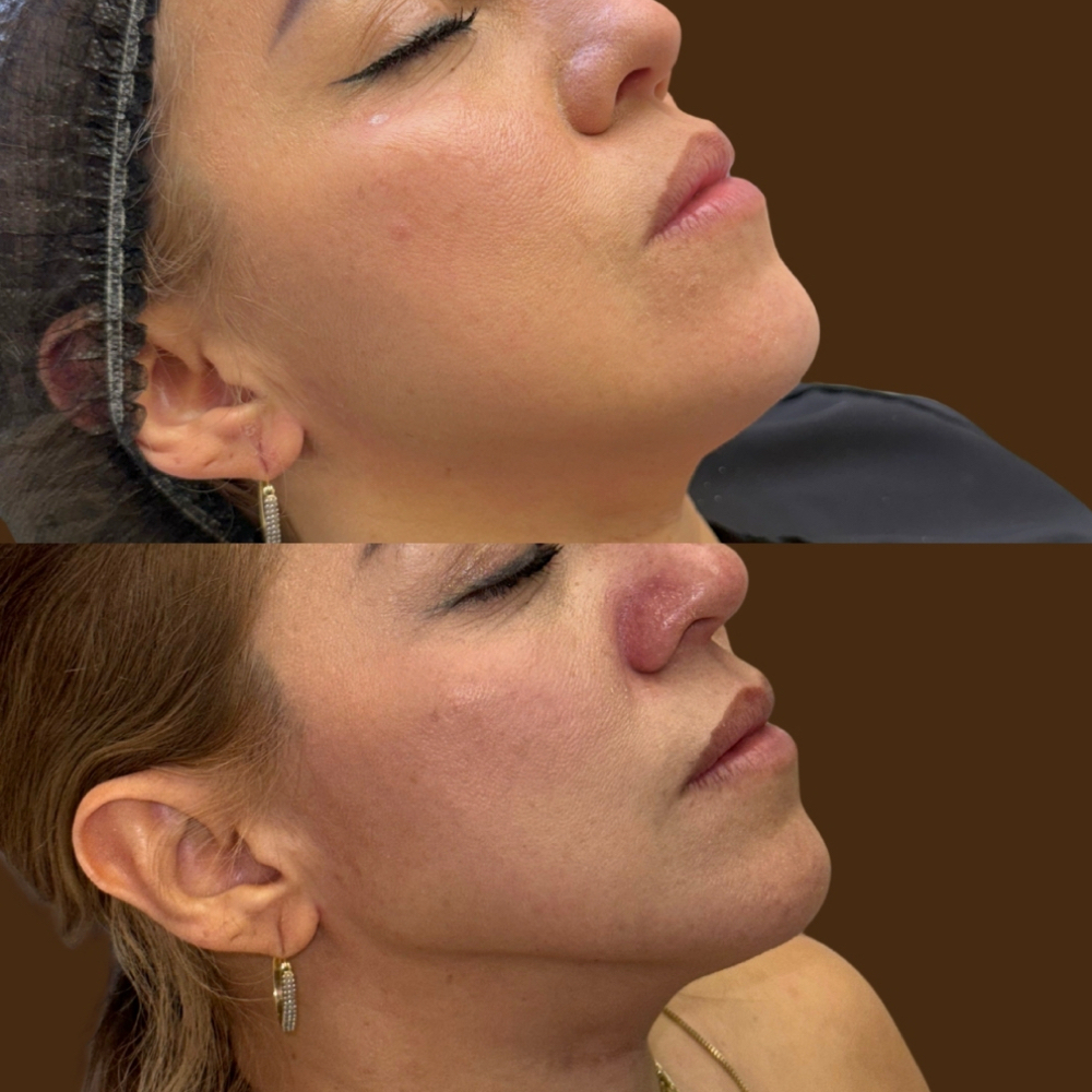 Jawline Filler at Aether Aesthetics in Midland, TX