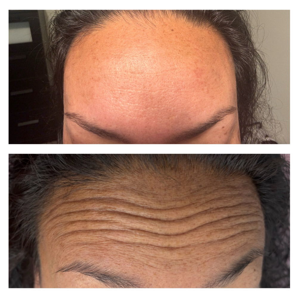 Botox at Magnolia Wellness and Aesthetics