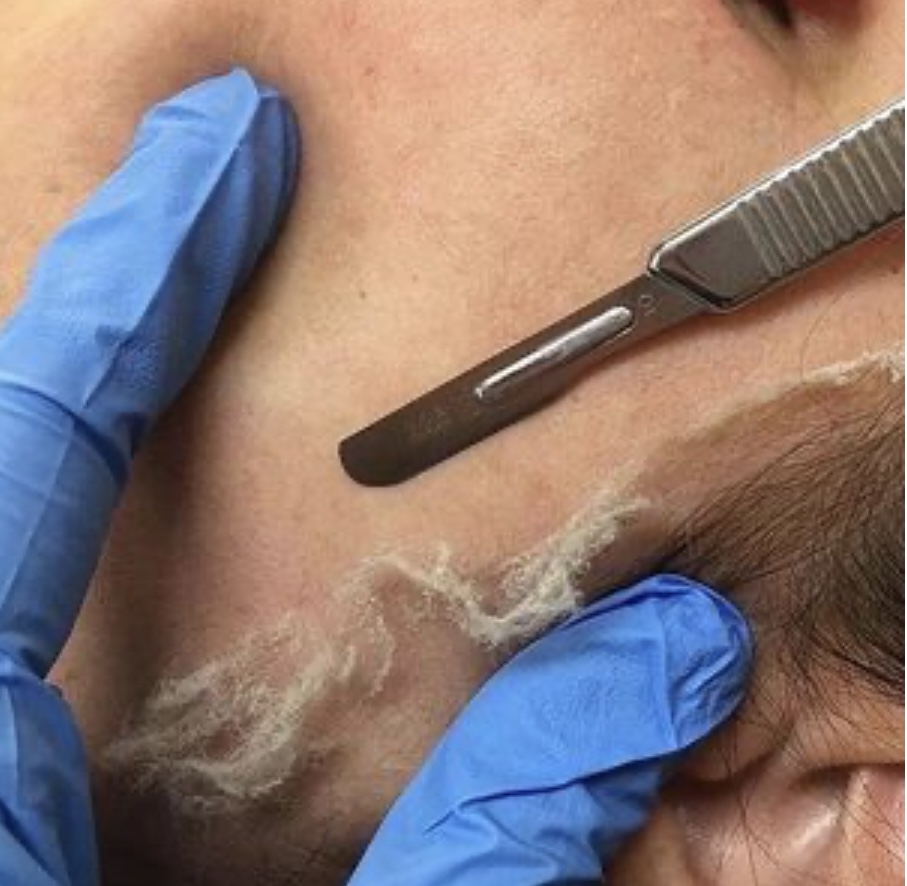 Dermaplane Facial