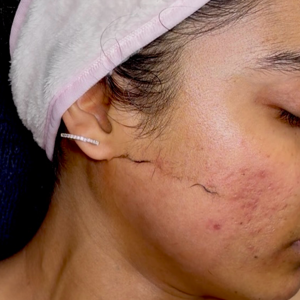 Dermaplanning Facial