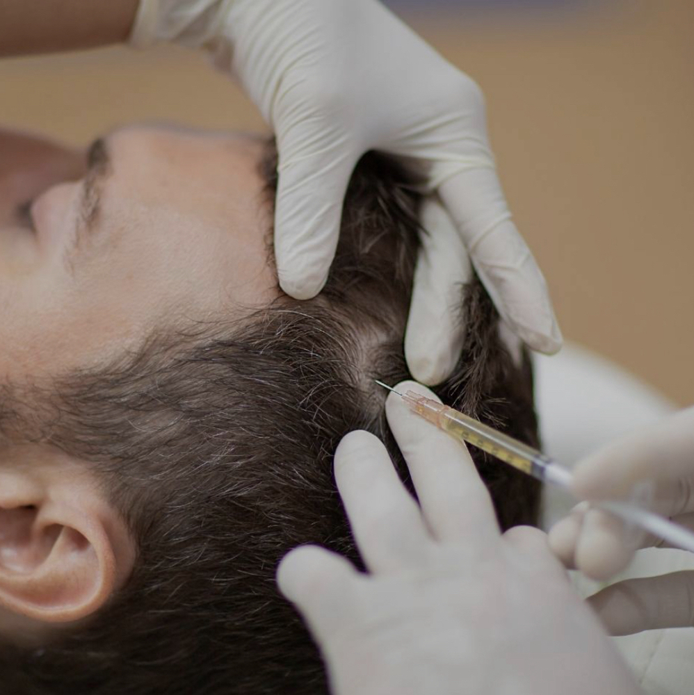 PRP Hair Restoration