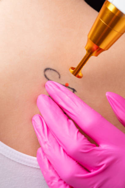 Laser Tattoo Removal