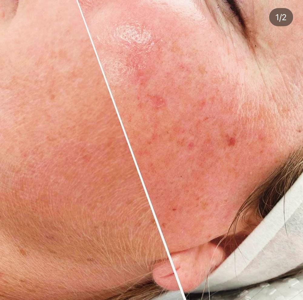 Dermaplaning Facial