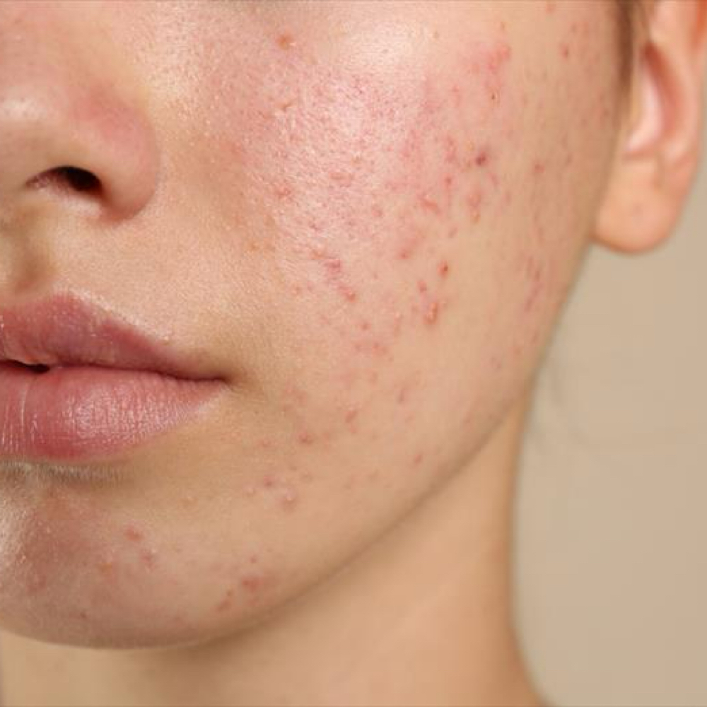 Thyme To Clear - Acne at Tiff Thyme Esthetics