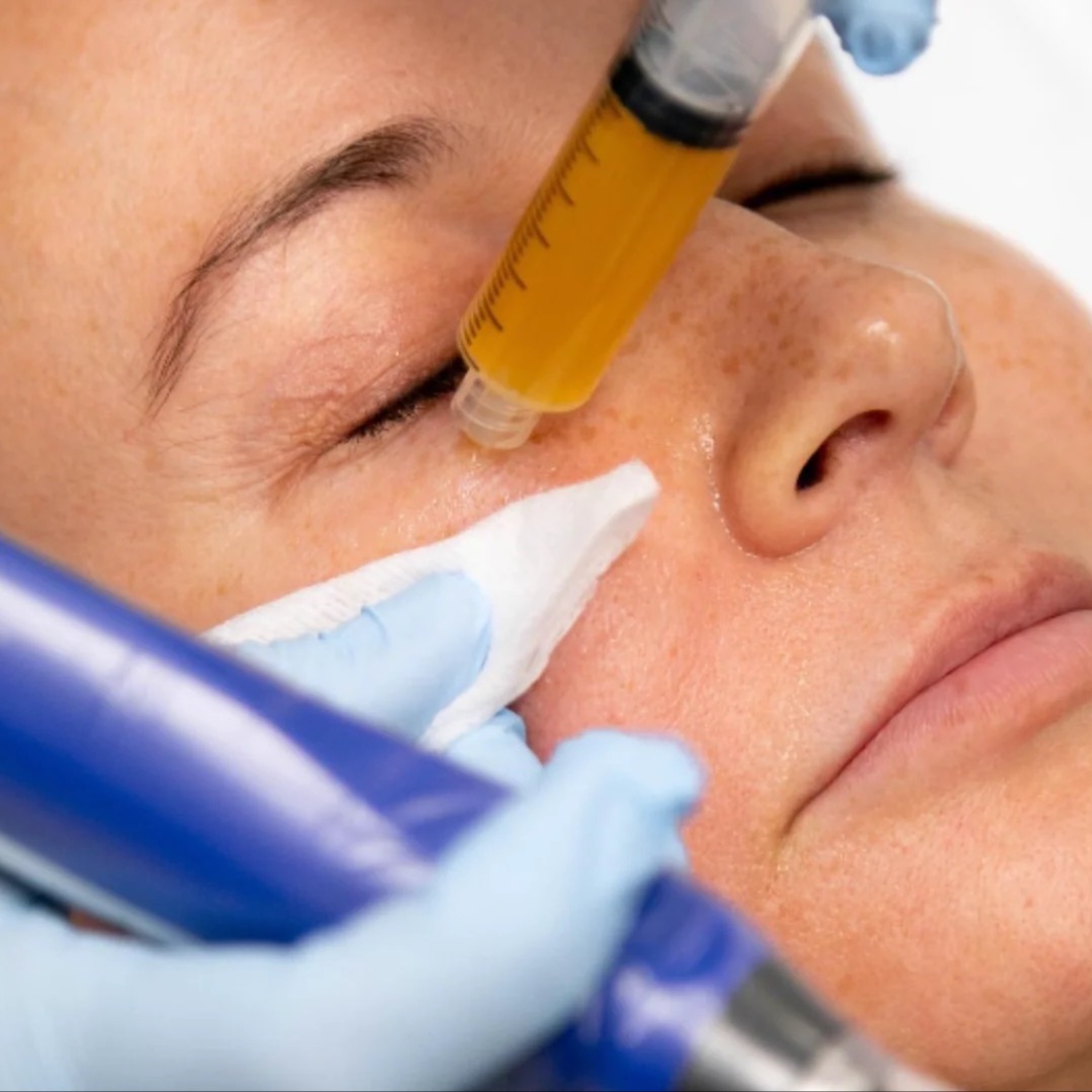 SkinPen Microneedling at Spa Ravine Med Aesthetics in wayne, NJ