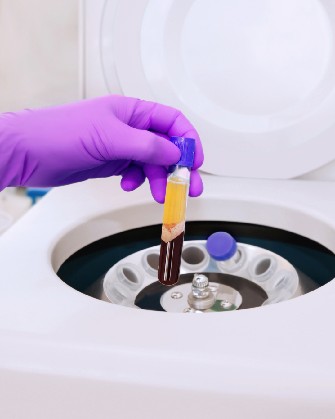 PRP Hair Restoration - Double Spin